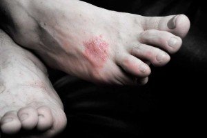 Pies con psoriasis