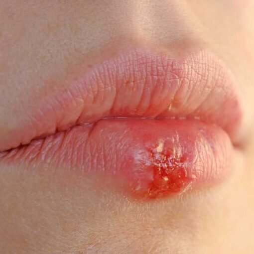 Mujer con herpes en los labios