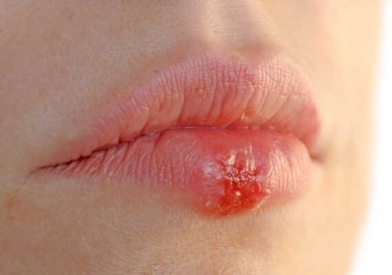 Mujer con herpes en los labios